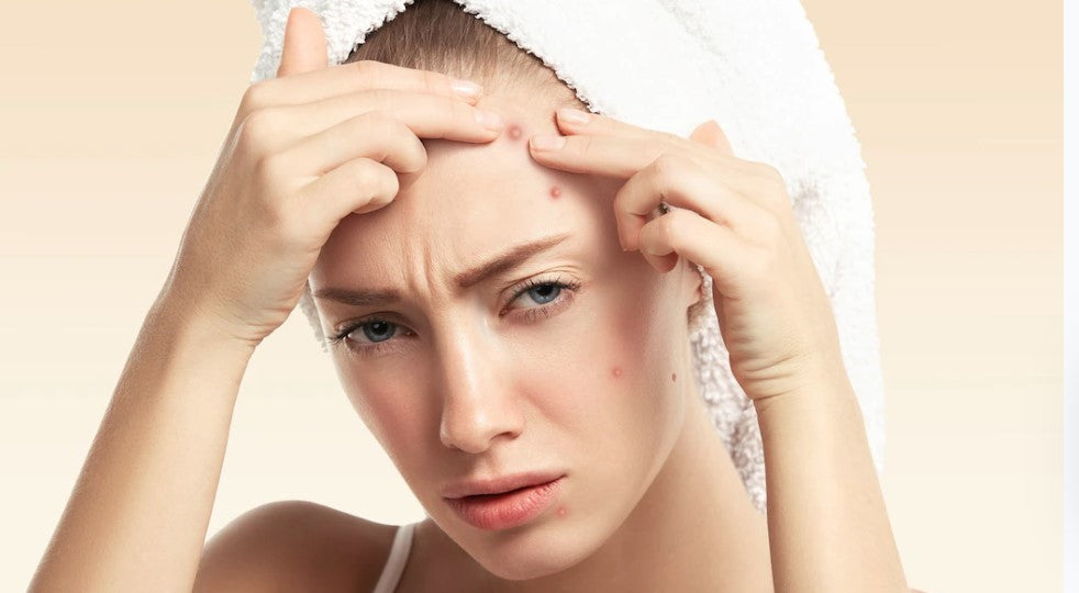 How to Get Rid of Pimples Fast - 4 Natural Ways!